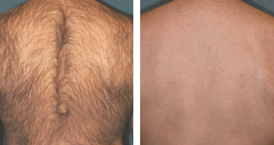 Laser hair removal back before after