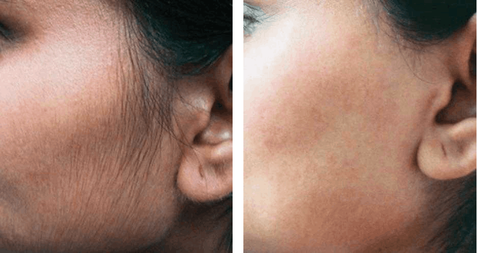Laser hair removal side of face before after